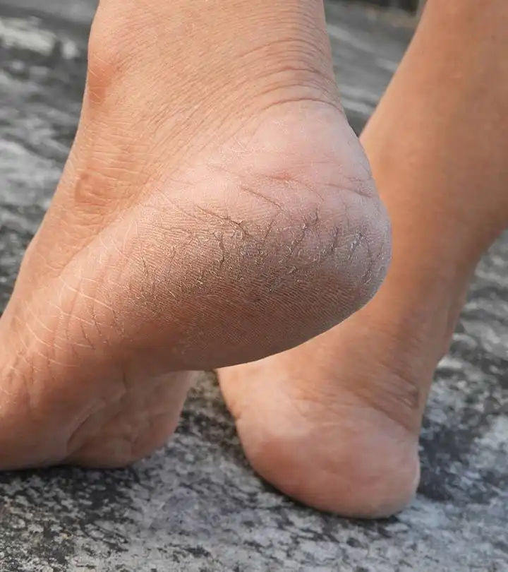 Bye Kaki Kasar! Cara Ampuh Atasi Tumit Seperti Tanah Sawah