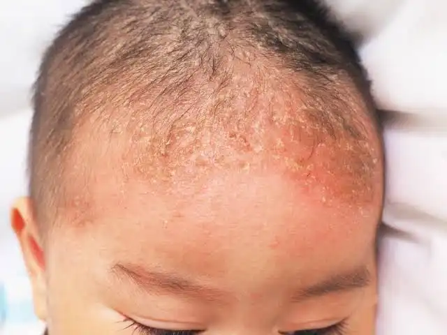 Kalau Muka Sensitif, Apa Ada Hubungannya dengan Kulit Kepala? Ini Penjelasan Ilmiahnya