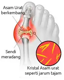 Mengenal Asam Urat: Penyebab, Gejala, dan Cara Mencegahnya