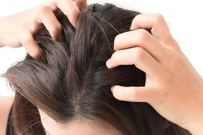 Rambut Gatal Terus-Menerus? Kenali Penyebabnya 
