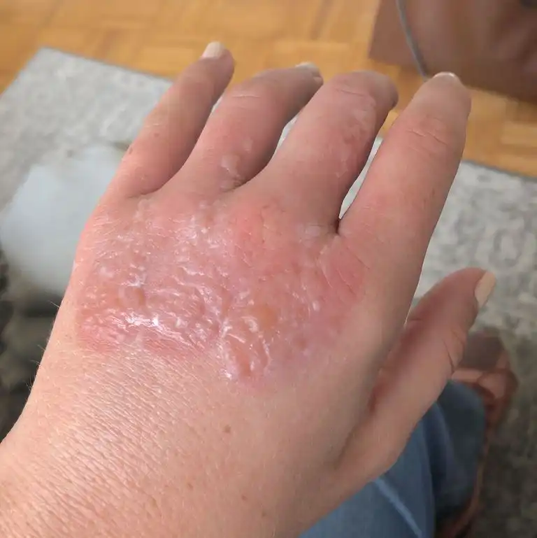 Cara Menghilangkan Bekas Luka Bakar agar Kulit Kembali Halus