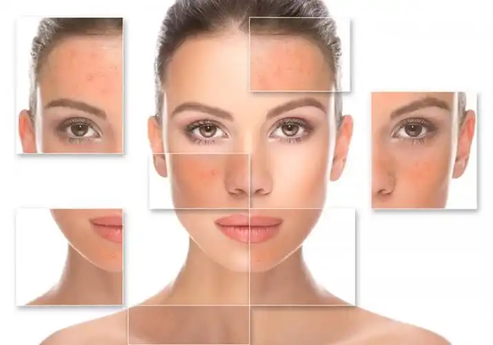 Memilih Kosmetik untuk Kulit Sensitif, Ini yang Perlu Diperhatikan
