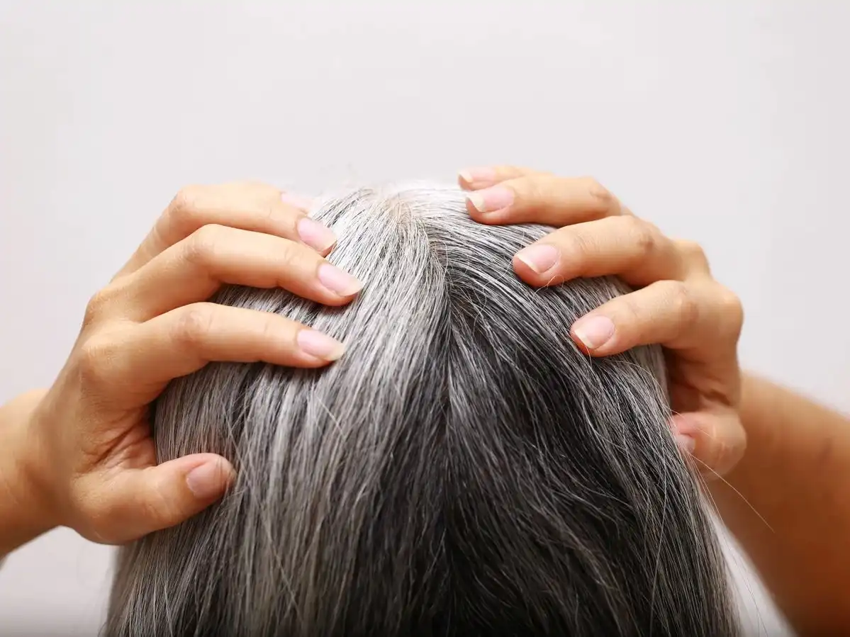 Rambut Beruban di Usia Muda, Kenali Faktor yang Bisa Memengaruhi Kemunculannya