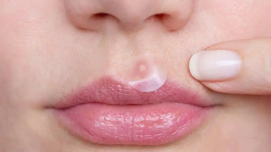 Dalam 1 Malam Lebih Tenang? Ini Daftar Acne Patch Favorit