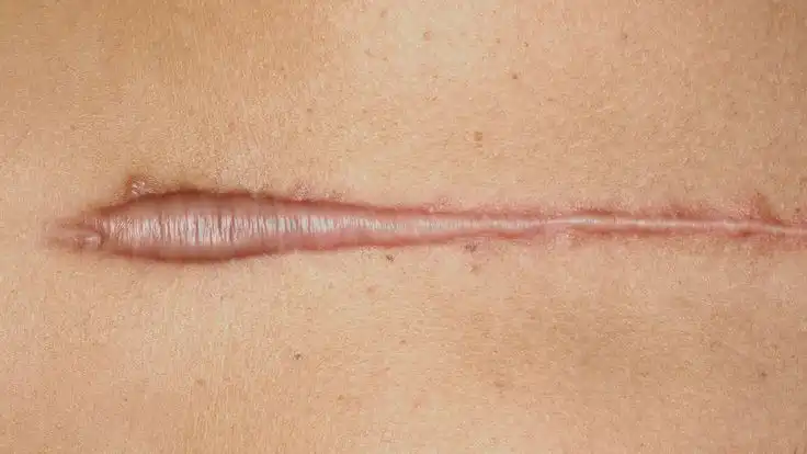 Punya Keloid? Kenali 8 Pilihan Perawatan dan Cara Mengatasinya