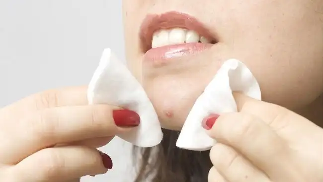 Kandungan Skincare yang Cocok untuk Kulit Berjerawat, Ini Penjelasan Ilmiahnya