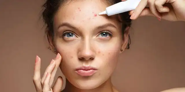 Jerawat di Jidat: Penyebab, Kebiasaan Sepele, dan Cara Mengatasinya dengan Tepat