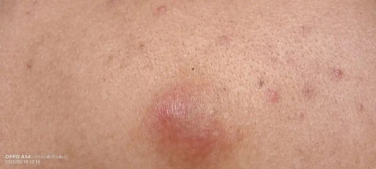 5 Makanan Penyebab Bisul Sering Muncul dan Cara Ampuh Mencegahnya Balik Lagi