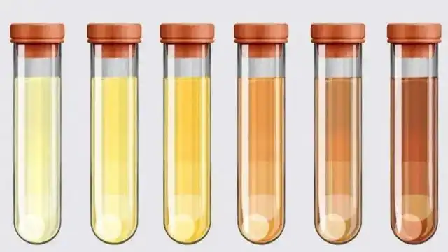 Warna Urine Berubah Setelah Minum Vitamin? Ini Penjelasannya
