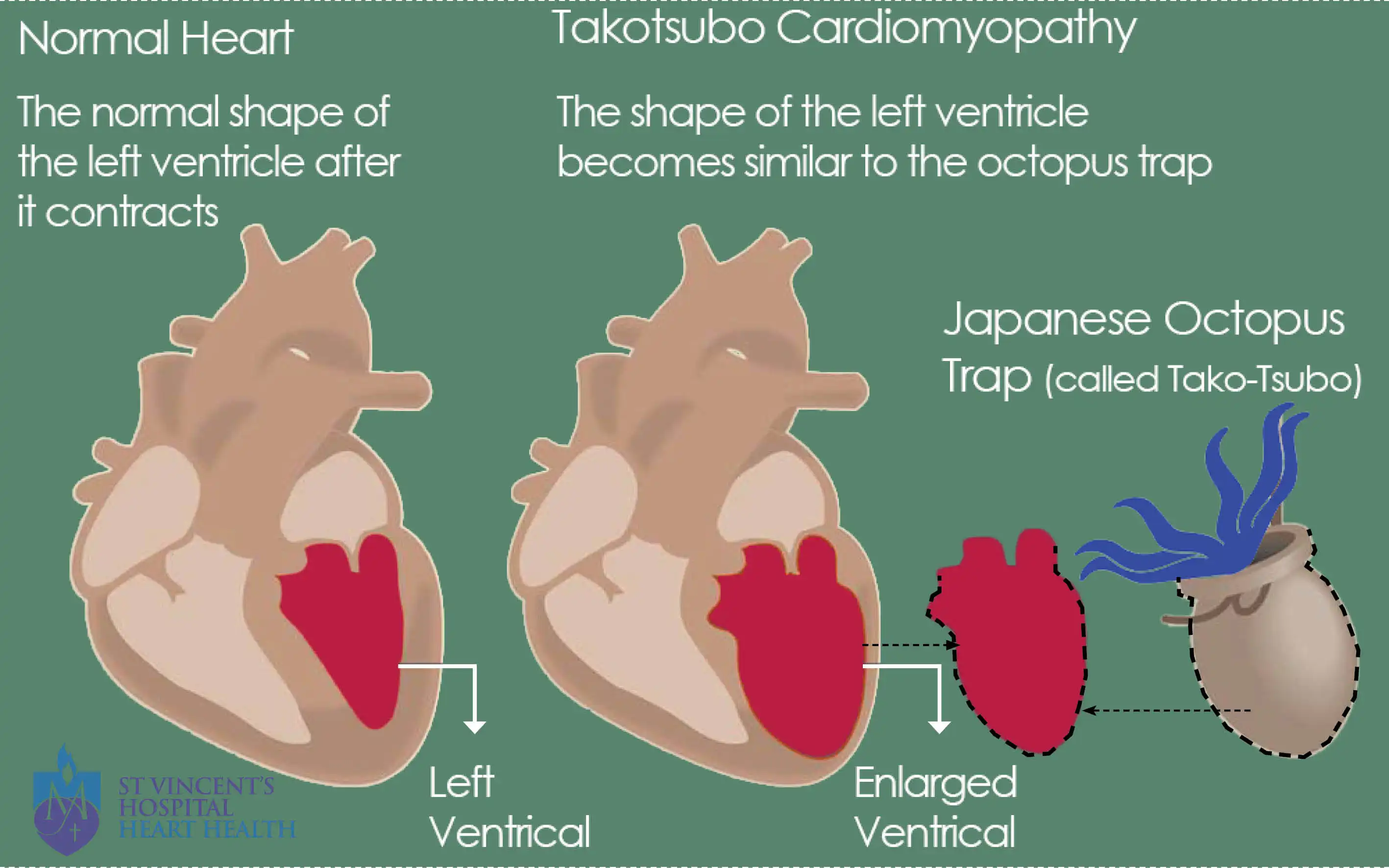 Takotsubo Cardiomyopathy: Saat Stres Bisa Melumpuhkan Jantung