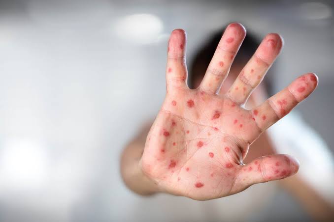 10 Anak di Pamekasan Positif Flu Singapura, Begini Penjelasan Dinas Kesehatan