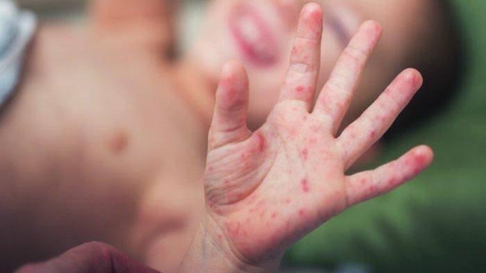 Sepanjang Februari-Juli 2025, Tercatat 800 Kasus Campak di Sumenep