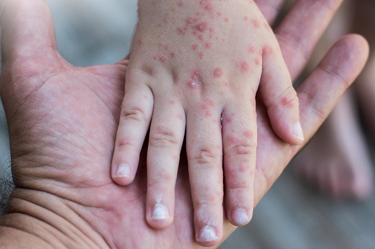 Seorang Balita di Sampang Meninggal Akibat Campak dan Gizi Buruk