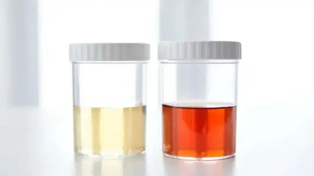 Mengapa Warna Urine Bisa Jadi Detektor Dehidrasi Paling Akurat?