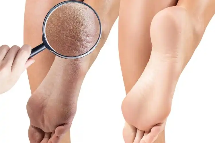Cara Mengatasi Tumit Kaki Pecah-Pecah dan Merawat Kelembapan Tangan di Rumah