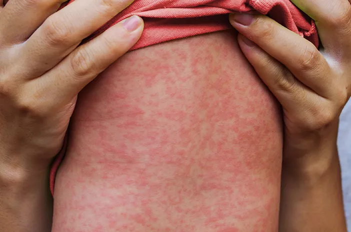 Mengenal Campak sebagai Virus Paling Menular dan Alasan Satu Pasien Bisa Picu 18 Kasus Baru