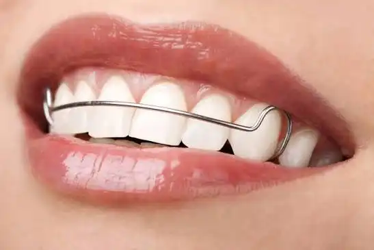 Jangan Salah Pilih! Perbedaan Retainer Kawat (Hawley), Transparan, dan Retainer Permanen