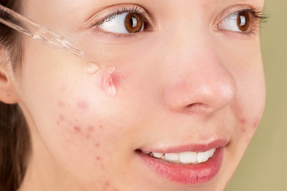 Bikin Gak Pede? Ini 5 Kandungan Skincare yang Ampuh Pudarkan Bekas Jerawat