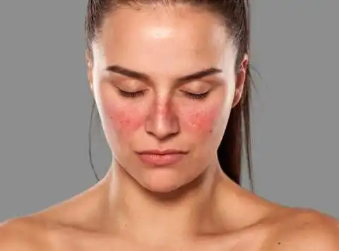 Bukan Sekadar Iritasi Kulit Inilah Fakta tentang Butterfly Rash yang Menjadi Ciri Khas Penyakit Lupus
