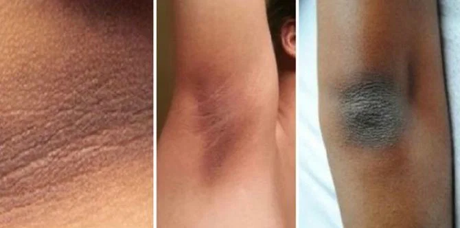 Cara Merawat Area Lipatan Tubuh Agar Bebas Bau Badan dan Tetap Halus