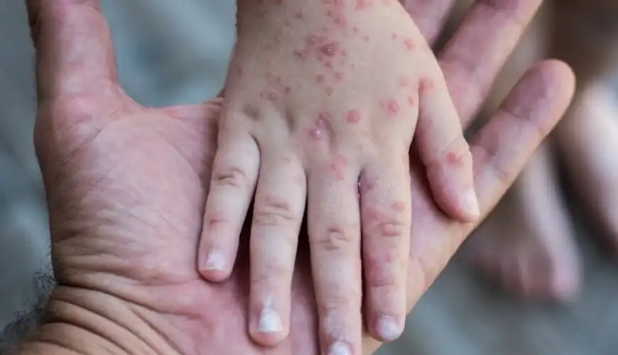 Waspada Bahaya Udara Sisa Pasien Campak yang Bisa Bertahan Hidup Selama Dua Jam