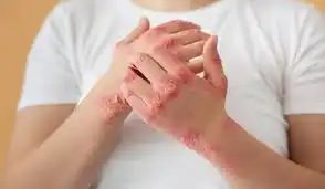 Jangan Salah Paham, Ini 5 Mitos tentang Penyakit Autoimun yang Gak Boleh Dipercaya
