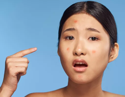 Jerawat 'Nastar' Menyerang? Ini Alasan Ilmiah Kenapa Wajah Bruntusan Pasca-Lebaran