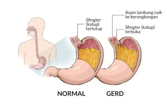 Pahami GERD: Gejala & Cara Hindari Reflux Sakit